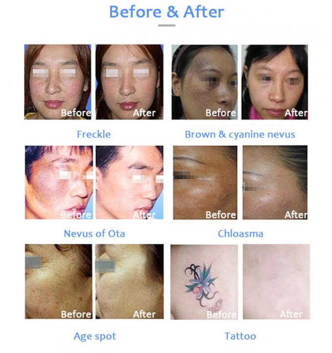 Máquina da beleza do tratamento dos problemas de pele da remoção da tatuagem do laser do picosegundo de Honkon com menos o Pih 1
