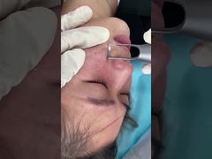 máquina do laser do picosegundo do salão de beleza de 1064nm 532nm para o tratamento do problema das lesões da pigmentação da pele