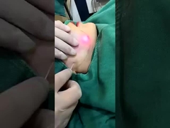 Máquina de Redução de Gordura a Laser de Diodo de 1470nm Profissional Resultados visíveis em 2-3 sessões